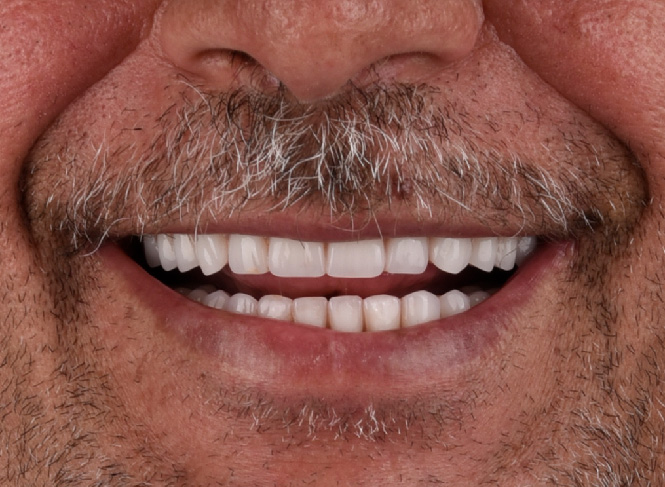 Transforming Smiles with Dental Implants in Bowral: Expert Care at Sydney Implant Institute