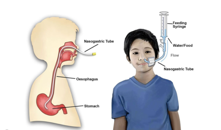 NG Tube: Uses, Benefits, Care, and Important Medical Facts