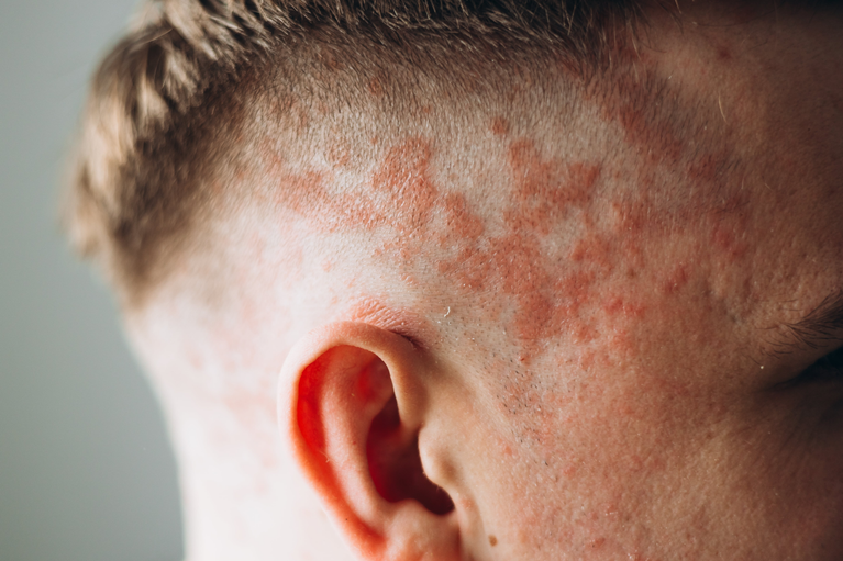 Comprehensive Guide to Psoriasis Treatment: Effective Strategies, Therapies, and Managing Symptoms